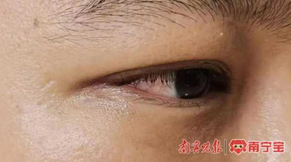 小伙使用酒店毛巾后被确诊淋病