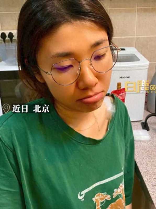 女子为减肥连吃3月胡萝卜变小橘人