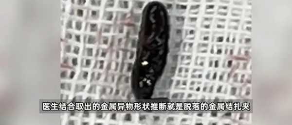 女子车祸后就医体内发现金属异物
