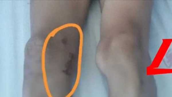 体育生左膝长骨瘤医生错切右膝